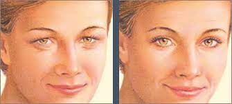 We did not find results for: Chirurgie Plastique De La Paupiere Blepharoplastie Centre Ophtalmo A Lyon Consultations Et Chirurgies Des Yeux