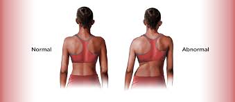 Many patients do need surgery to correct their spines. What Are The Signs Of Scoliosis In Children Children S Healthcare Of Atlanta