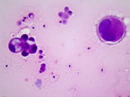 Pleural effusion can be treated to relieve patients' symptoms. Benign And Malignant Mesothelial Proliferation Surgical Pathology Clinics