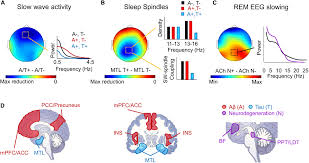 Frontiers | Local Sleep and Alzheimers Disease Pathophysiology