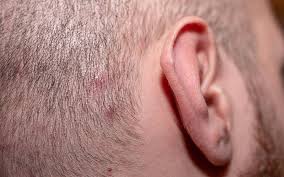 Waxing, sugaring, tweezing, and threading work by literally tearing your hair out. Pimples On The Scalp Why How Treatments Common Myths Skinkraft