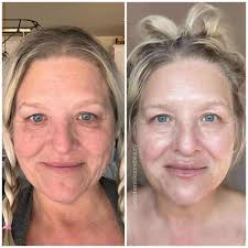 Improving skin with natural products and patience