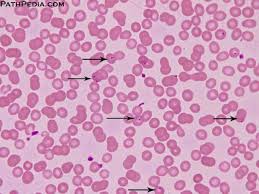On the diversity of malaria parasites in african apes and the origin of p. Histopathology Images Of Malaria By Pathpedia Com Pathology E Atlas