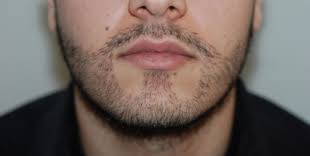 Foren sind nützliche plattformen zum austausch. Korperhaartransplantation Kostenlose Informationen Und Beratung Zu Korperhaartransplantation Haartransplantation Haare Bart