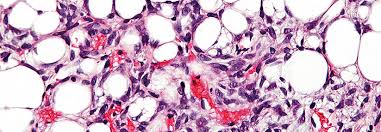 Polymyalgien Bei Alteren Patienten Rheuma Oder Tumorerkrankung Medical Tribune