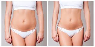 Image result for Liposuction