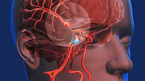 De wikipedia, la enciclopedia libre. Sabes Que Es Un Accidente Cerebrovascular Los Tipos De Acv Y Como Identificar Los Primeros Sintomas Alo Doctor