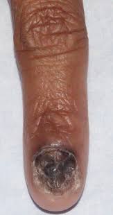 Image result for Onychotillomania feet