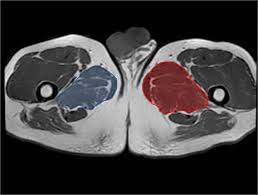 Image result for Obturator Nerve Compression
