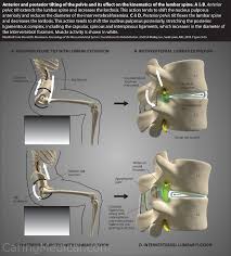 Symptoms are typically limited in duration and follow a pattern: Treatments For Leg Length Discrepancy Pelvic Tilt Pelvic Incidence Lumbar Lordosis Mismatch And Walking Difficulties Caring Medical Florida