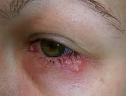 Little known immunity nutrient that helps heal herpes. Eye Herpes Pictures Symptoms And Types