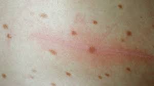 Image result for Urticaria pigmentosa children