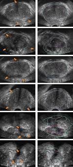 Your doctor will want to discuss treatment options as well as the prognosis for bladder cancer. Https Arxiv Org Pdf 1907 01743