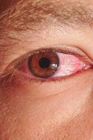 Image result for Conjunctivitis Resources