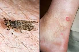 It burns and itches, has little ant bite type bumps. Insect Bites And Stings Symptoms Nhs