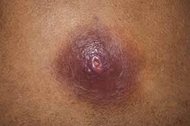 Image result for Skin Abscess