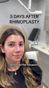 5 days vs 1 month after a minimally invasive rhinoplasty for our second pro  bono charity rhinoplasty! We love to see our patients seeing their nose for  the first time! DM us today to schedule a free ...