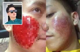 Madu semua sedia maklum bahawa madu adalah raja segala makanan. Gelek Sampai Berdarah Bro Ni Selamba Lukakan Wajah Nak Hapus Parut Jerawat Batu Saya Buat Kajian Dari Internet Viral Mstar