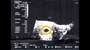 Can a blighted ovum cause anembryonic pregnancy? Anembryonic Pregnancy Article