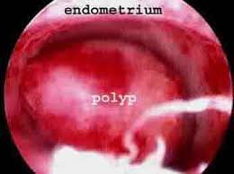 They may have a large flat base (sessile) or be attached to the uterus by an elongated pedicle (pedunculated). Endometrial Uterine Polyps And How They Affect Fertility