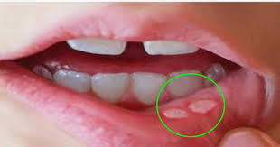 Canker Sores Are The Absolute Worst Here Is How To Get Rid Of Them Fast The Healthiest Alternative Canker Sore Cankers Mouth Ulcers