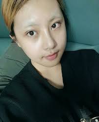 Zygoma Reduction & V-line