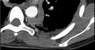 Benign multicystic peritoneal mesothelioma (bmpm) is a rare neoplasm of. Https Www Openaccessjournals Com Articles Diagnostic Imaging And Workup Of Malignant Pleural Mesothelioma Pdf