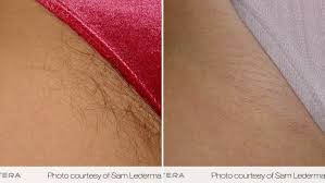 Waxing is another popular approach but involves ripping and tearing at your hair Coolglide Laser Hair Removal Lakes Dermatology