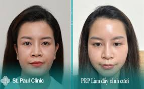 Làm Đầy Rãnh Cười Bằng PRP Hot Nhất Hiện Nay có gì đặc biệt?