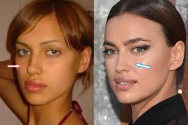 Months after kanye west parted ways with kim kardashian, he has reportedly started dating irina shayk. Irina Shayk Plastic Surgery Boob Job Nose Lips