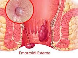 Emorroidi Esterne Come Sgonfiarle E Farle Rientrare