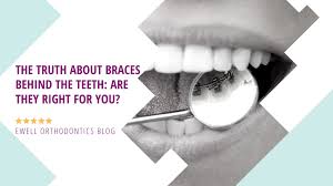 Sometimes your dentist may need to put a stitch in the empty socket to help it heal. The Truth About Braces Behind The Teeth Are They Right For You Ewell Orthodontics