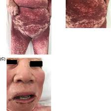 PDF) Severe Cutaneous Adverse Reaction Caused by Carbamazepine and  Levofloxacin After Varicella Zoster Virus Infection