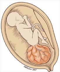 Womb cancer develops in the lining or the wall of your womb. Sacrococcygeal Teratoma Cs Mott Children S Hospital Michigan Medicine