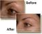 Deep Ingrown Eyebrow Hair