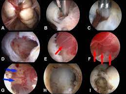 These patches of tissue are called implants, nodules, or lesions. they are most often found on or under the ovaries Progress In The Diagnosis And Management Of Adolescent Endometriosis An Opinion Reproductive Biomedicine Online