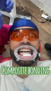 Guess who just got a smile makeover! 🦷✨ Reuben Collins @reubencollins_  officially joined the perfect smile club with his stunning composite  bonding transformation. We're thrilled to have helped him achieve his  flawless,