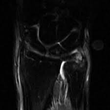 D + full tear of the lunotriquetral ligament and arthrosis. Tfcc Injury Palmer 1b Radiology Case Radiopaedia Org