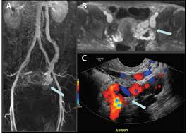Treatment Strategies For Varying Patterns And Presentations Of Pelvic Venous Disorder Endovascular Today