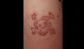 Black Henna Tattoos Can Cause Severe Skin Reactions Case Shows Black Henna Henna Tattoo Tattoo Skin