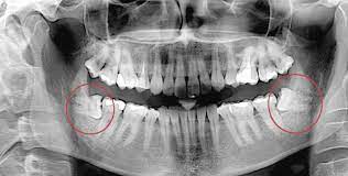 We did not find results for: Wisdom Teeth Recovery Guide