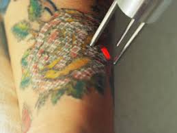 As the only tattoo removal dedicated facility between lubbock and ft. Free Laser Tattoo Removal Services In Florence Kentucky