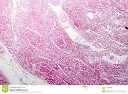 De wikipedia, la enciclopedia libre. Miocarditis Bacteriana Enfermedad Cardiaca Inflamatoria Histopatologia Foto De Archivo Imagen De Ciencia Microscopio 120408692