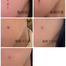 ちょっと後悔しているほくろ除去の経過 | 妻です。ママです。女です。