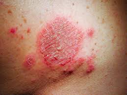 Image result for Eczema nummulare