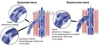 Seperti apakah cara herbal tersebut? Operasi Vena Varikos Bahagian Kaki Bawah Tapak Mengenai Vena Varikos