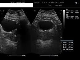 Ureteric Stone Prostate Hypertrophy Image Radiopaedia Org
