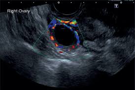 Ultrasound can better assess if the cyst is more information: Sonographic Assessment Of Ovarian Cysts And Masses Chapter 8 Gynaecological Ultrasound Scanning