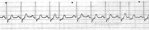 Acute management of paroxysmal supraventricular tachycardia (psvt) includes controlling the rate and preventing hemodynamic collapse. Paroxysmal Supraventricular Tachycardia Ecg Guru Instructor Resources