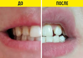 как убрать черные точки на зубах в домашних условиях My Proverili 5 Sposobov Otbelivaniya Zubov V Domashnih Usloviyah Soda Nas Razocharovala